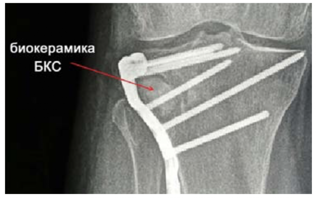 Сделано в Ростехе: биокерамика